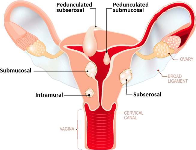 Fibroid locations